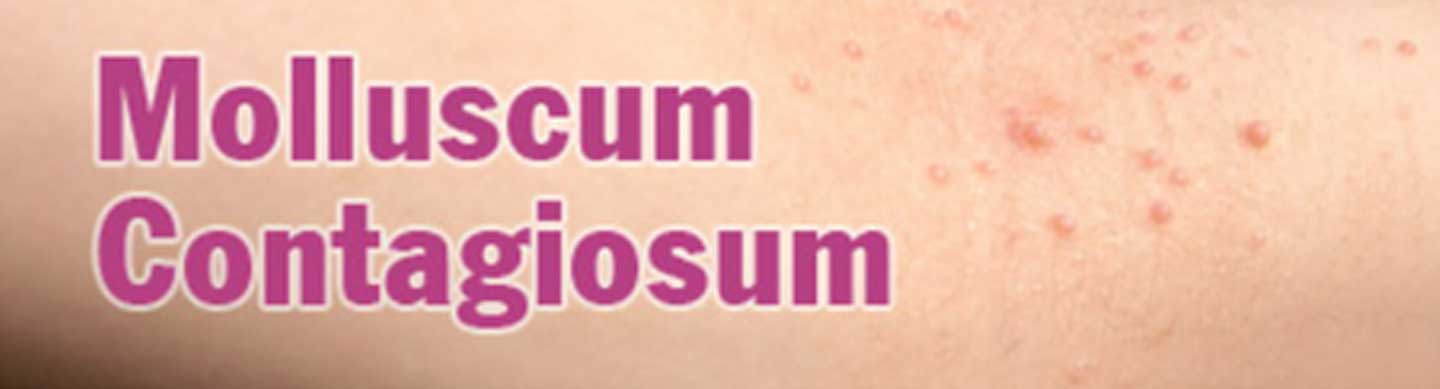 Symptoms Causes And Diagnosis Of Molluscum Contagiosum 2720